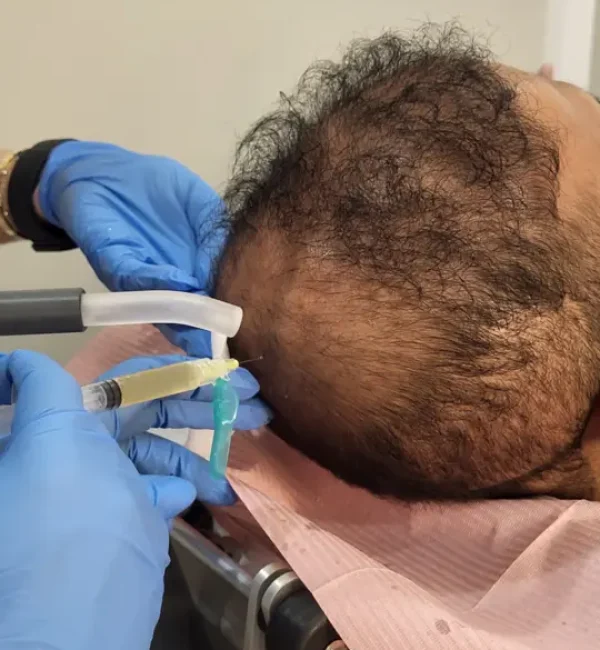PRP Hair (1st Image)