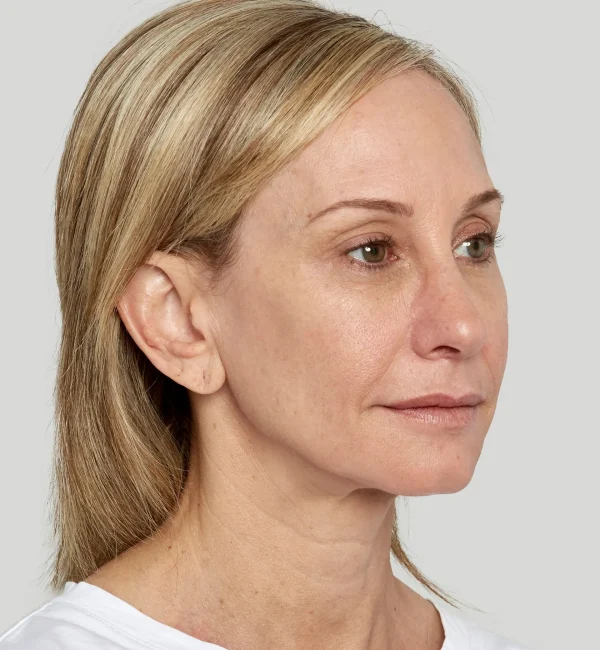 Sculptra injectables aw medspa